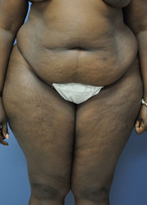 Mini Tummy Tuck, Dr. Nia Banks, Beaux Arts Institute of Plastic Surgery, Washington, DC