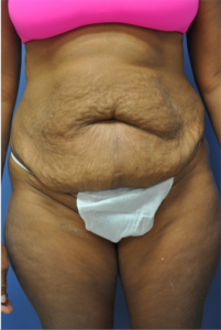 Mini Tummy Tuck, Dr. Nia Banks, Beaux Arts Institute of Plastic Surgery, Washington, DC