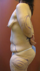 Body Lift, Dr. Nia Banks, Beaux Arts Institute of Plastic Surgery, Washington, DC