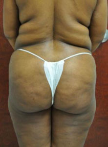 Brazilian Butt Lift, Dr. Nia Banks, Beaux Arts Institute of Plastic Surgery, Washington, DC