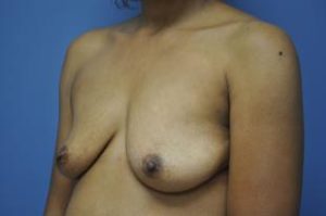 Breast Augmentation, Dr. Nia Banks, Beaux Arts Institute of Plastic Surgery, Washington, DC