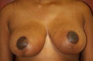 Breast Reduction, Dr. Nia Banks, Beaux Arts Institute of Plastic Surgery, Washington, DC