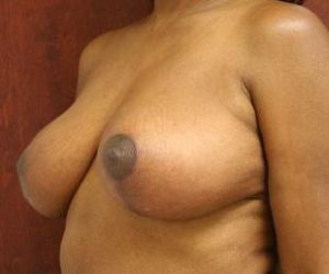 Breast Lift, Dr. Nia Banks, Beaux Arts Institute of Plastic Surgery, Washington, DC