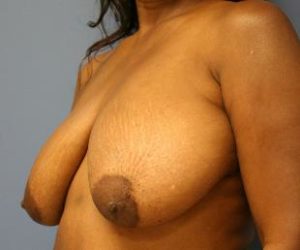 Breast Lift, Dr. Nia Banks, Beaux Arts Institute of Plastic Surgery, Washington, DC