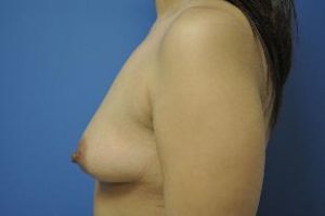 Breast Augmentation, Dr. Nia Banks, Beaux Arts Institute of Plastic Surgery, Washington, DC