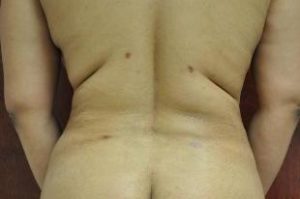 Liposuction, Dr. Nia Banks, Beaux Arts Institute of Plastic Surgery, Washington, DC