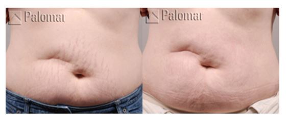 Stretch Mark Removal, Dr. Nia Banks, Beaux Arts Institute of Plastic Surgery, Washington, DC