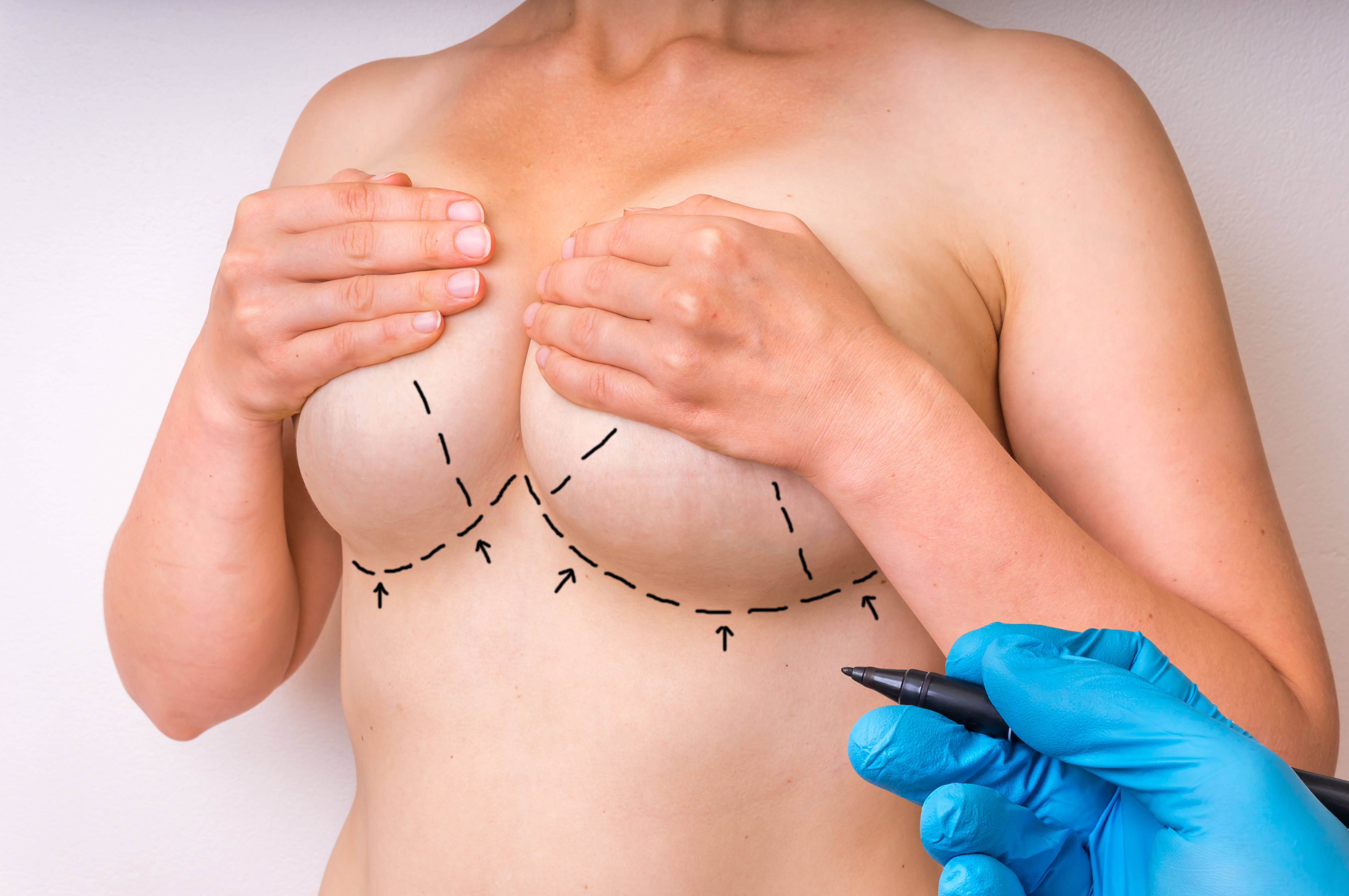 Breast Reduction Near Washington DC