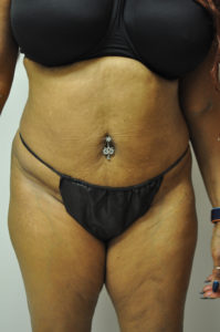 Liposuction, Dr. Nia Banks, Beaux Arts Institute of Plastic Surgery, Washington, DC